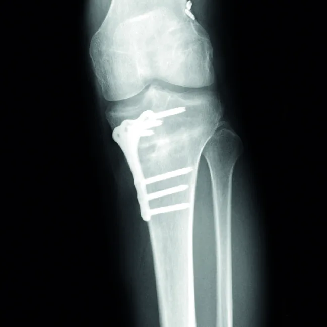 Preoperative xray 01